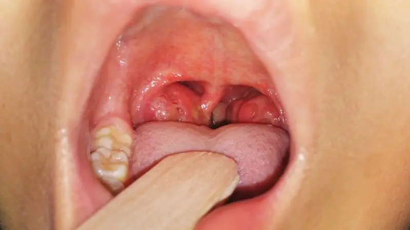 Placas en la garganta que desaparecen solas: Causas, síntomas y tratamiento - Cómo saber si las placas son viricas o bacterianas placas en la garganta que desaparecen solas - Cómo saber si las placas son viricas o bacterianas