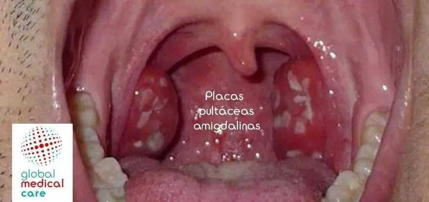 Placas garganta virus se van por si solas: Tratamiento y cuidados - Cuánto duran las placas Viricas placas garganta virus se van por si solas - Cuánto duran las placas Viricas