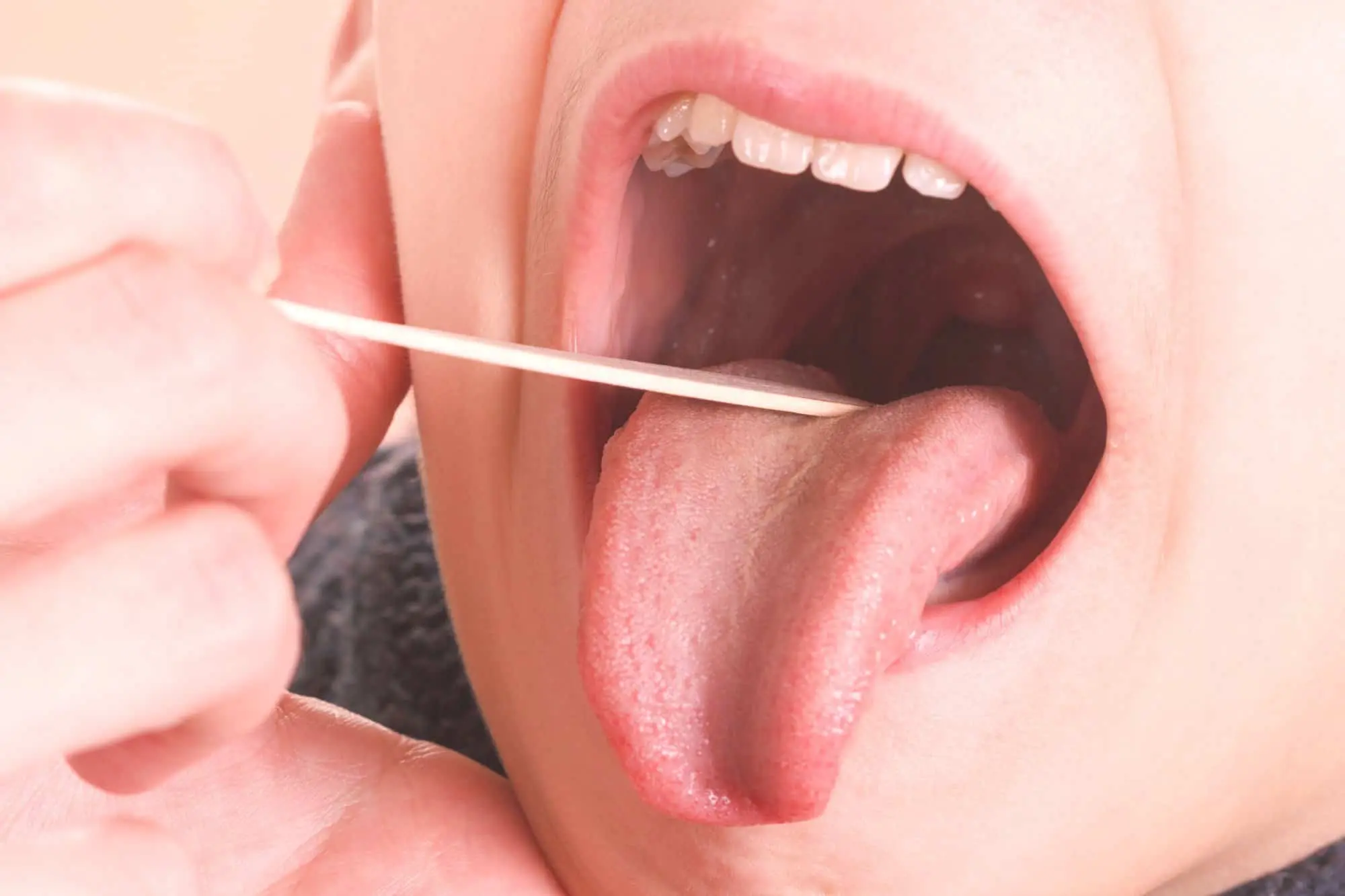 las placas de pus se van solas - Qué pasa si no se trata una amigdalitis bacteriana