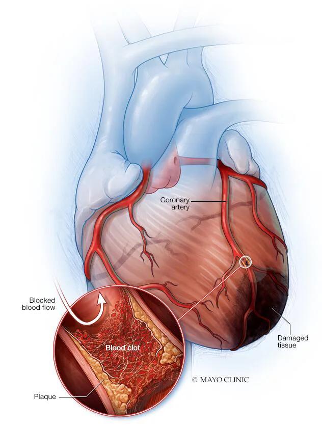 enfermedad de un solo vaso infarto en jovenes rotura placa - Qué son las placas en las arterias coronarias